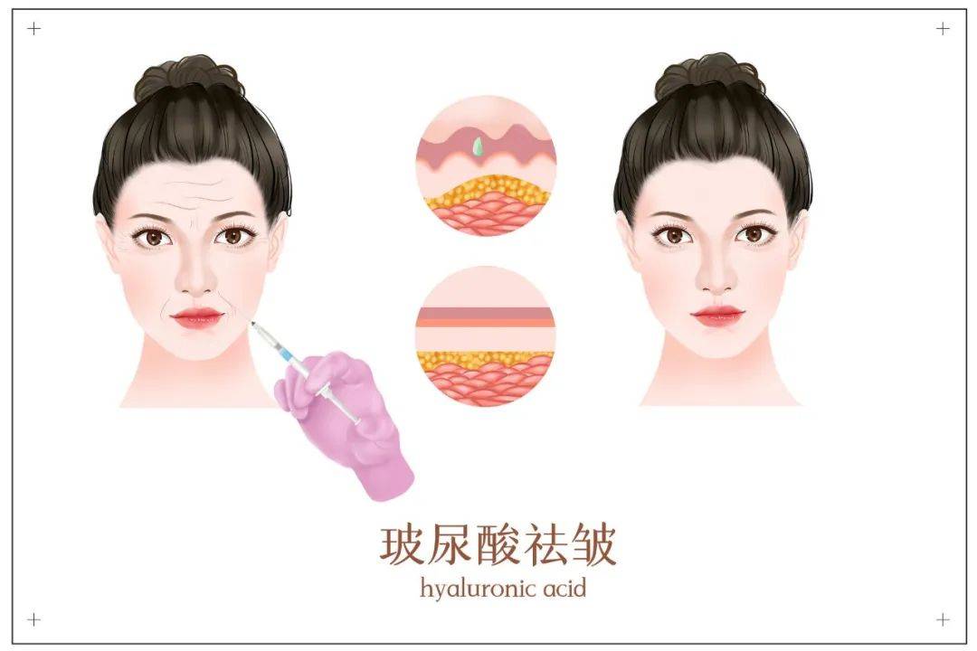 苹果版全局透明皮肤
:【广州艺星】玻尿酸填充=脸僵？你确定自己真的“整”明白了吗？